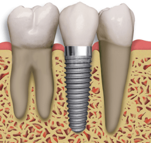 implantes dentales en lima